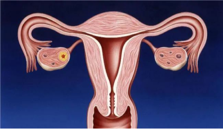 港大妇女儿童医院提醒：当心被子宫肌瘤“盯上”！